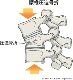 腰椎圧迫骨折