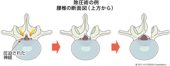除圧術の例腰椎の断面図（上方から）