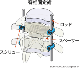 脊椎固定術