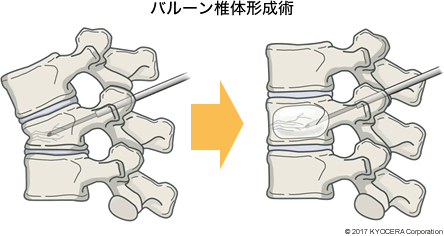 バルーン椎体形成術