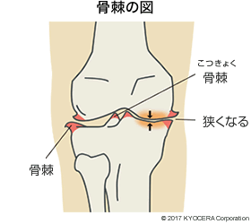 骨棘の図