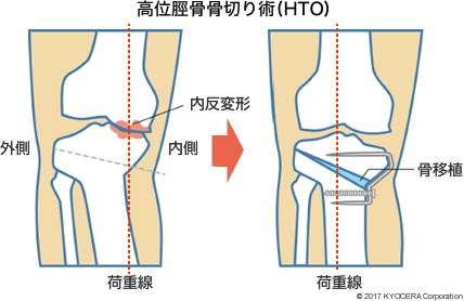 高位脛骨骨切り術(HTO)