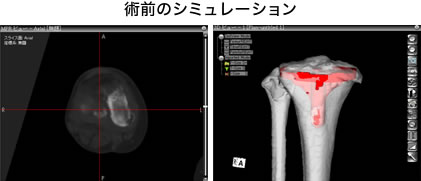 術前のシミュレーション