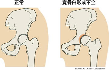 正常 寛骨臼形成不全