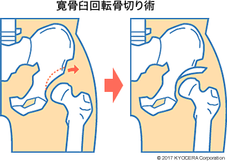 寛骨臼回転骨切り術