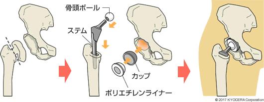 人工股関節全置換術の例