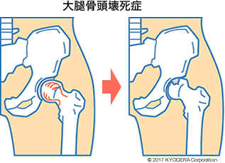 大腿骨頭壊死症