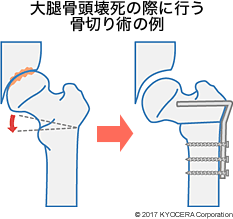 大腿骨頭壊死の際に行う骨切り術の例