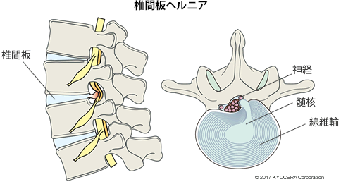 椎間板ヘルニア