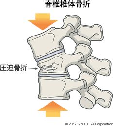 脊椎椎体骨折