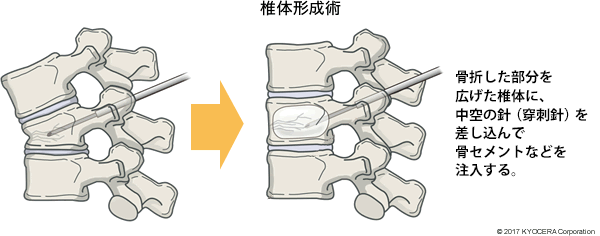 椎体形成術