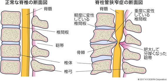 正常な脊椎の断面図、脊柱管狭窄症の断面図