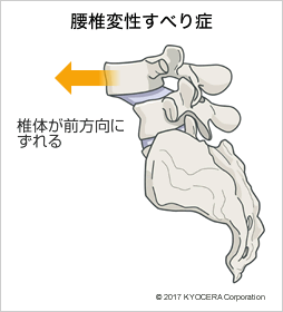 腰椎変性すべり症