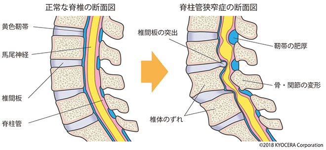 正常な脊椎の断面図、脊柱管狭窄症の断面図