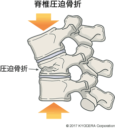 脊椎圧迫骨折