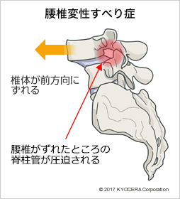 腰椎変性すべり症