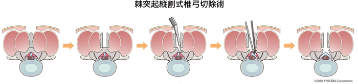 棘突起縦割式椎弓切除術