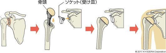 従来タイプの人工肩関節置換術の例