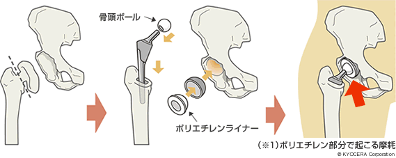 （※１）ポリエチレン部分で起こる摩耗