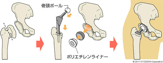正常な脊椎の断面図、脊柱管狭窄症の断面図