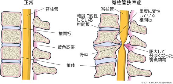 正常な腰部脊椎の断面図、腰部脊柱管狭窄症の断面図