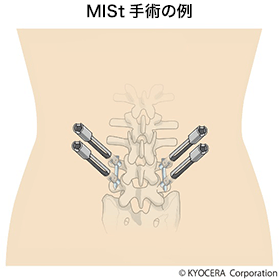 MISt手術の例