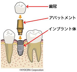 インプラント