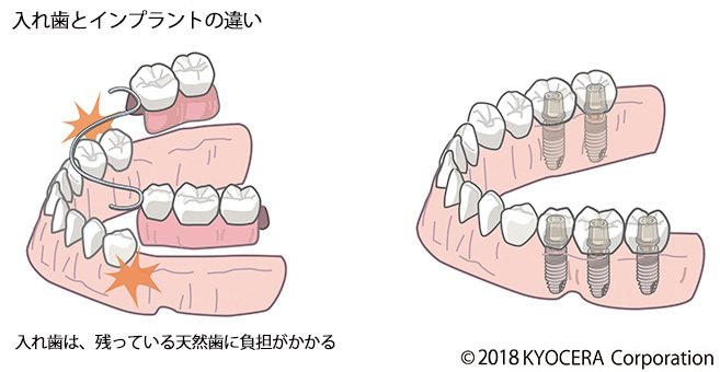 インプラントで入れ歯を固定する