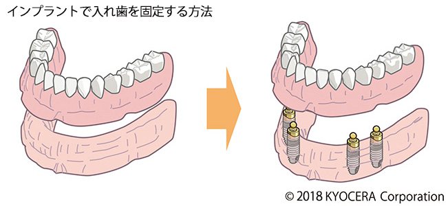 インプラント埋入の手順