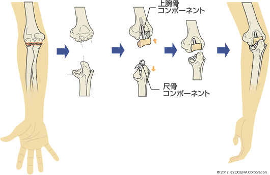 人工肘関節置換術の例