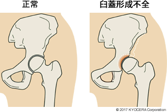 臼蓋形成不全