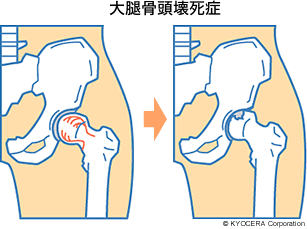 大腿骨頭壊死症