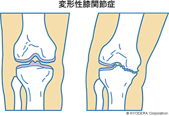 変形性膝関節症