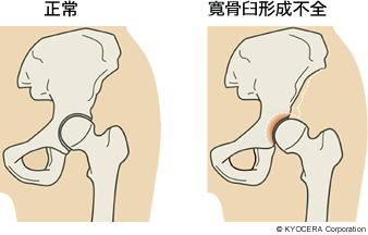 臼蓋形成不全