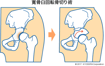 寛骨臼回転骨切り術