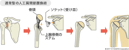通常型の人工肩関節置換術