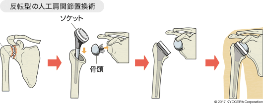 反転型の人工肩関節置換術