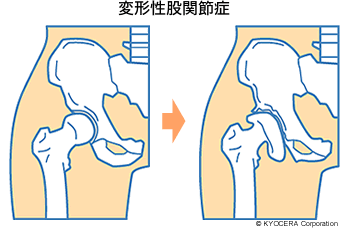 変形性股関節症