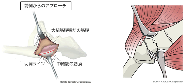 前側からのアプローチ