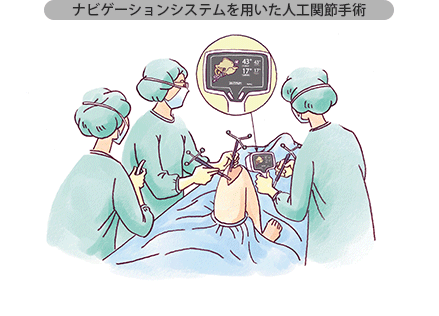 ナビゲーションシステムを用いた人工関節手術