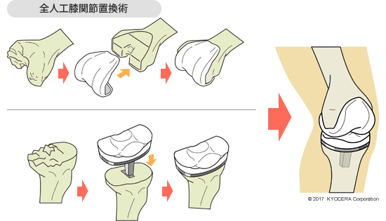 人工関節全置換術（TKA）