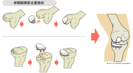 単顆人工膝関節置換術（UKA）