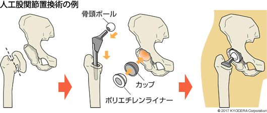 人工股関節置換術の例