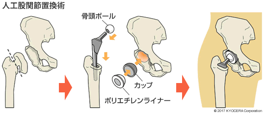 人工股関節置換術