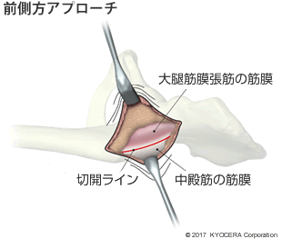 前方アプローチ