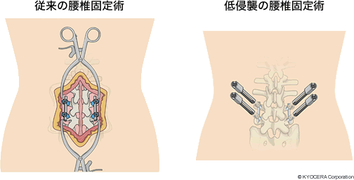 低侵襲によるいろいろなアプローチ（切開方法）