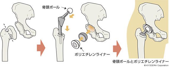 骨頭ボールとポリエチレンライナー