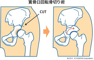 寛骨臼回転骨切り術