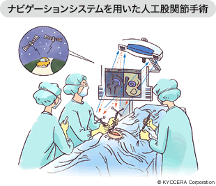 ナビゲーションシステムを用いた人口関節手術