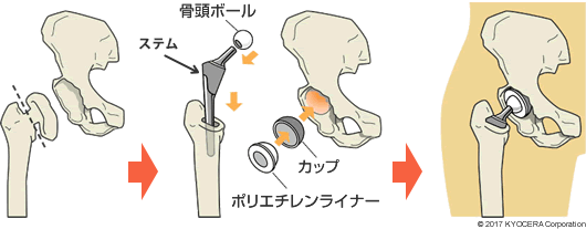 人工股関節置換術の例